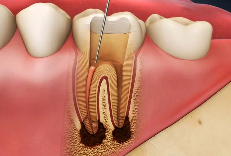 Diagram of a root canal.